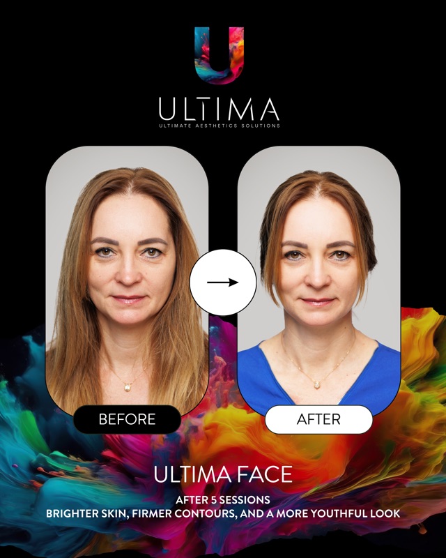 ULTIMA Face eredmény — bőrfeszesség javulás, 5 alkalom után