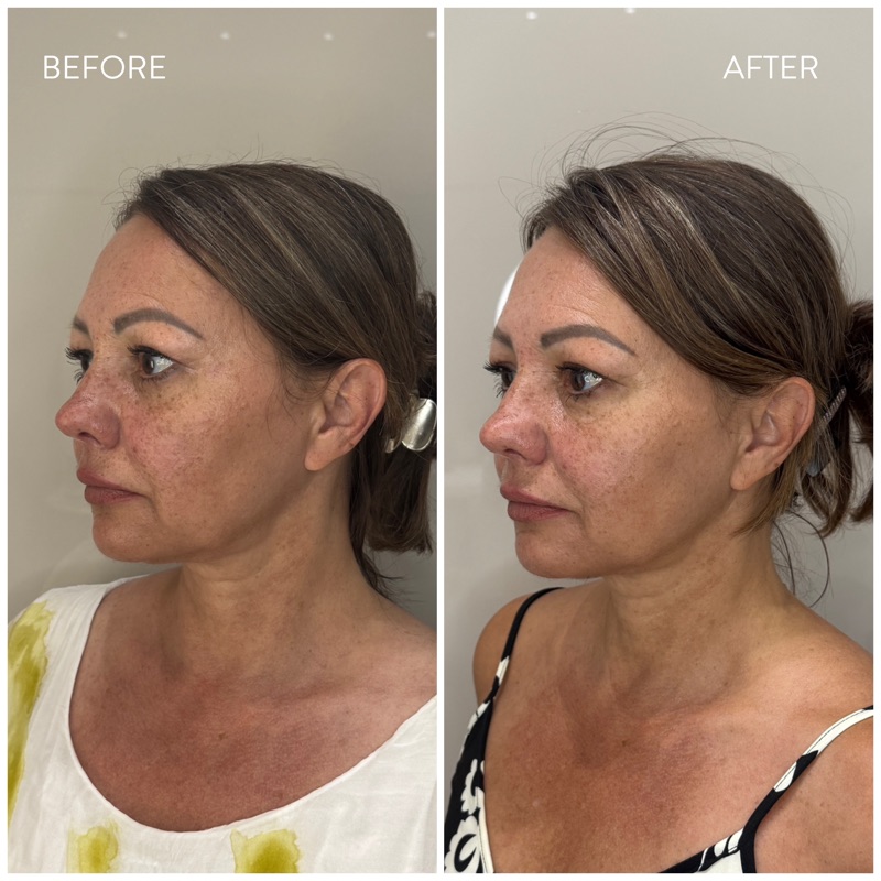 ULTIMA Face eredmény — jawline kontúr javulás