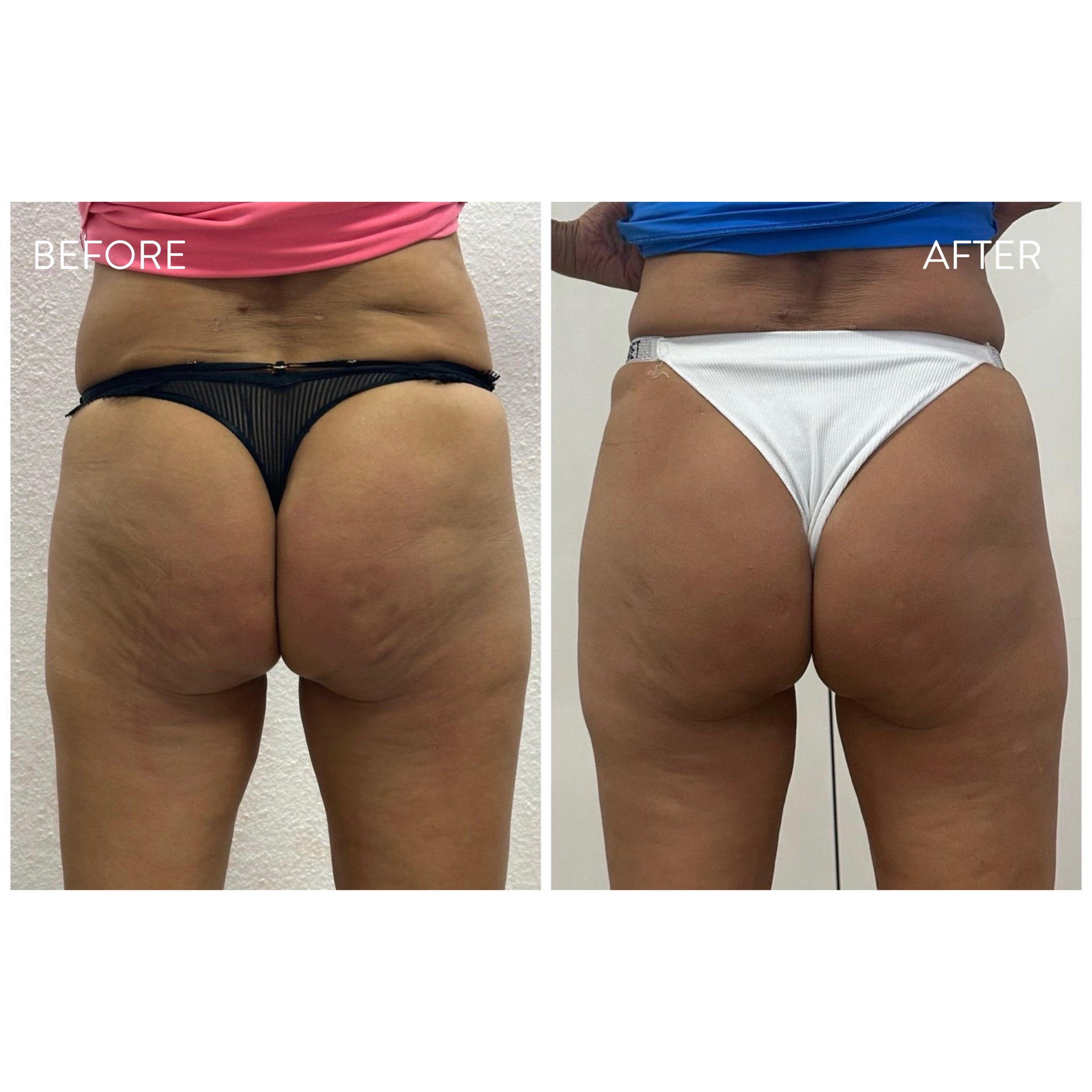 Fenék before/after — saját páciens