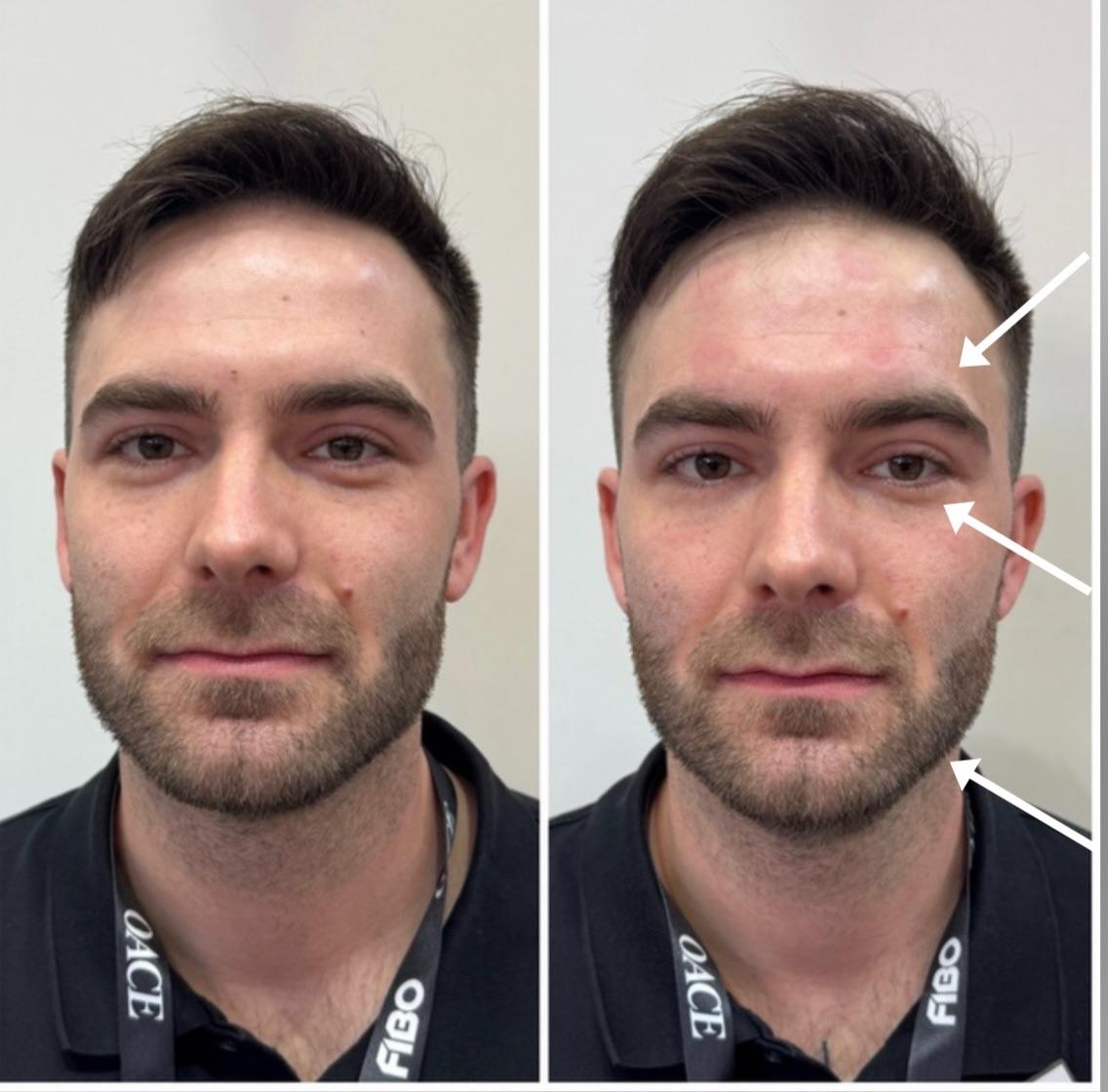 Férfi jawline előtte-utána