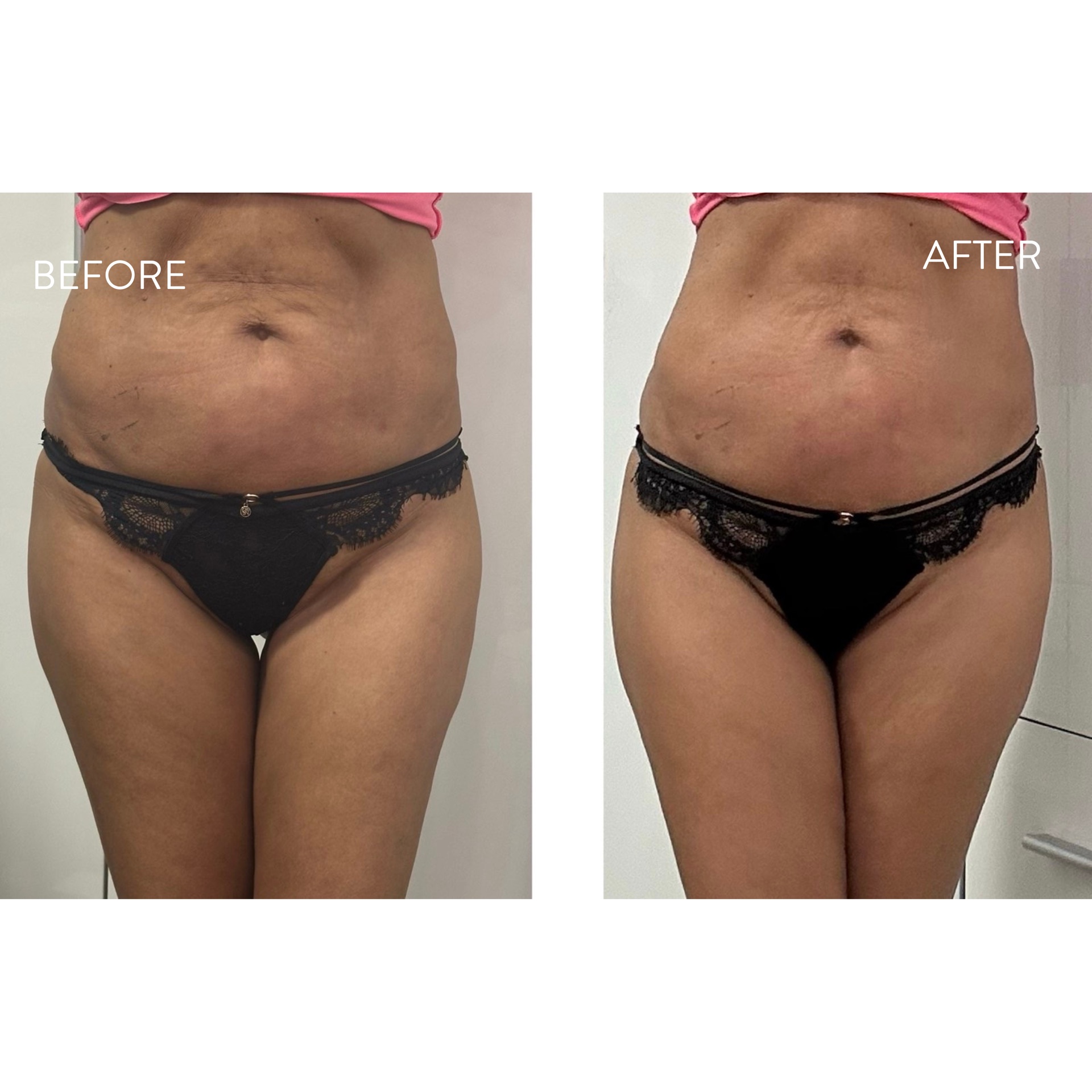 Hasfal before/after