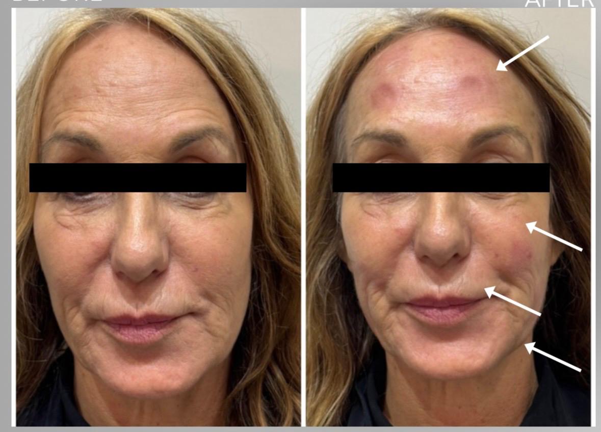 Arcfiatalítás előtte-utána