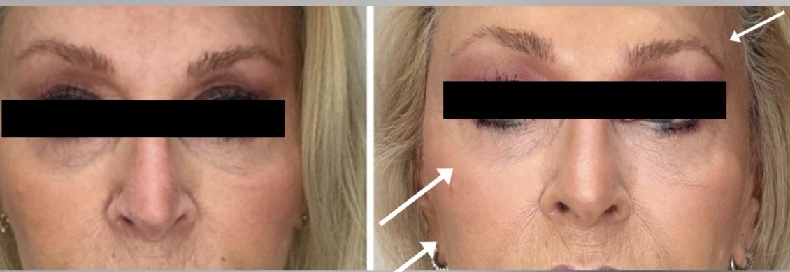 Szemkörnyék előtte-utána