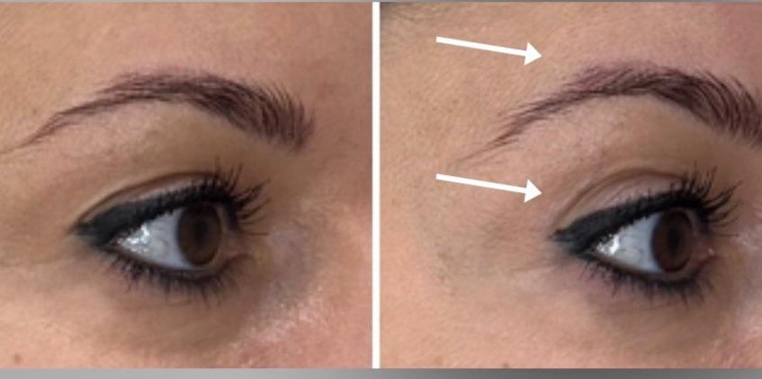 Szemkörnyék bőrminőség javulás