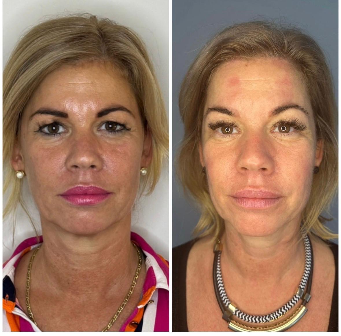 Bőrminőség javulás előtte-utána